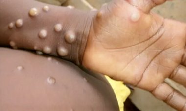 Primul caz de variola maimuţei a fost identificat în Italia