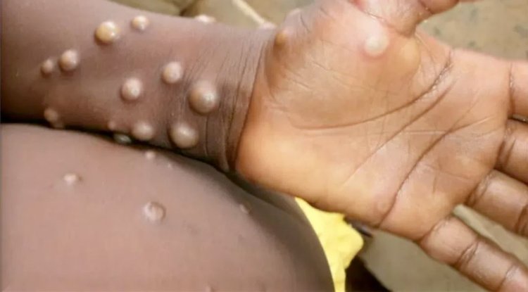 Primul caz de variola maimuţei a fost identificat în Italia