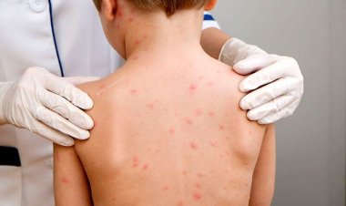 Ministerul Sănătăţii a declarat epidemie de rujeolă la nivel naţional