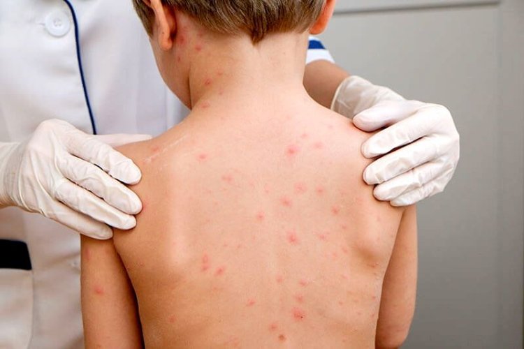 Ministerul Sănătăţii a declarat epidemie de rujeolă la nivel naţional